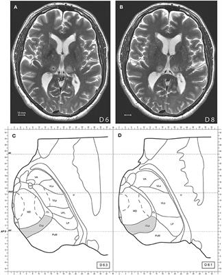 MR-Guided Focused Ultrasound Central Lateral Thalamotomy for Trigeminal Neuralgia. Single Center Experience